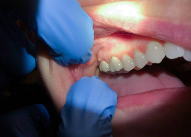 Best Emergency Care for Gum Disease in Lake Meade, PA